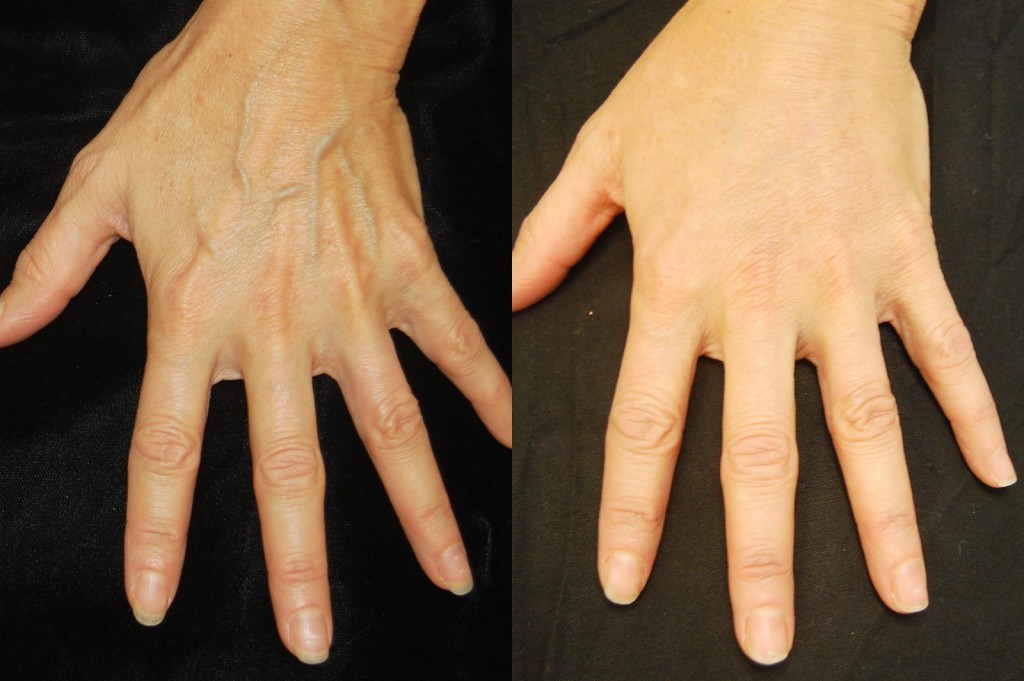 Ways to Rejuvenate SunDamaged Hands News at Salmon Creek Plastic Surgery