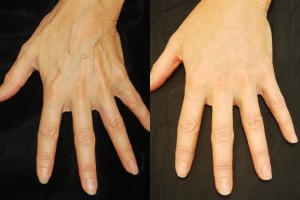 Hand-Rejuvenation-1