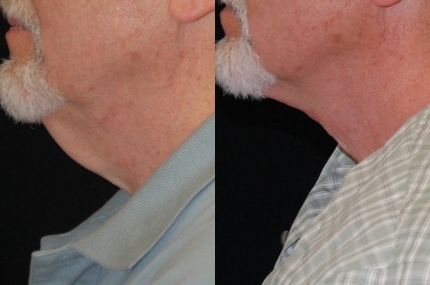 What To Do About That Neck Wattle - News at Salmon Creek Plastic Surgery